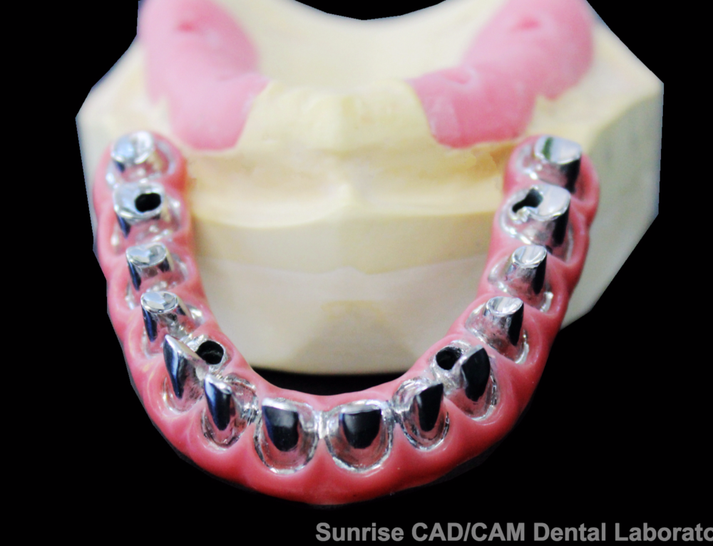 Individual Crowns Sunrise Dental Lab